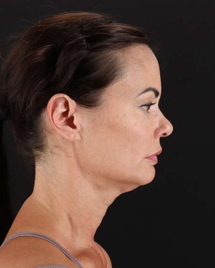 All Me Facelift Before & After Patient #483