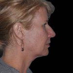 All Me Facelift Before & After Patient #263