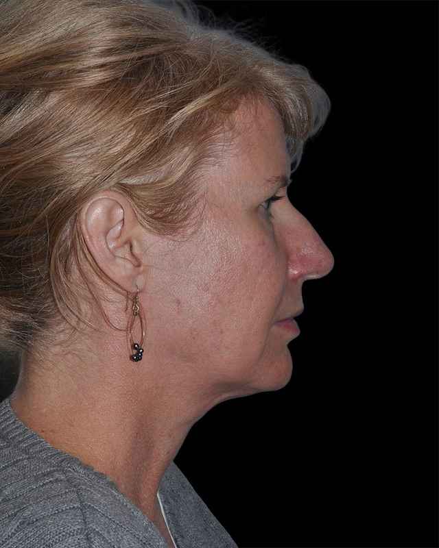 All Me Facelift Before & After Patient #263