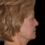 All Me Facelift Before & After Patient #274