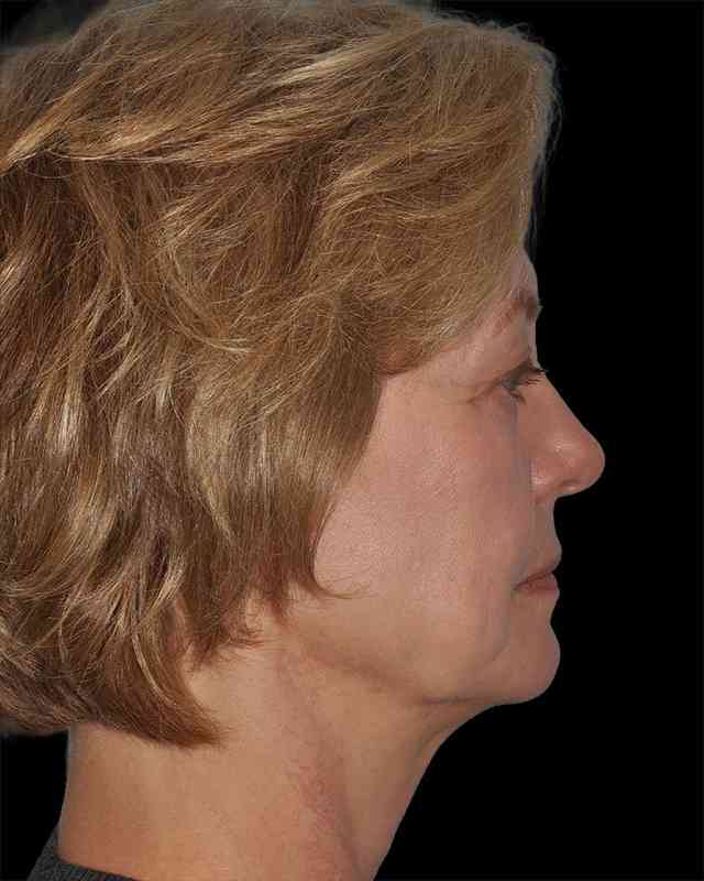 All Me Facelift Before & After Patient #274
