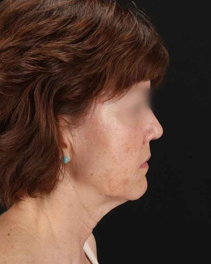 All Me Facelift Before & After Patient #229