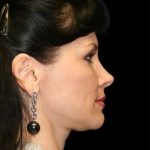 All Me Facelift Before & After Patient #286
