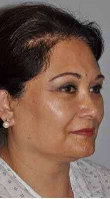 All Me Facelift Before & After Patient #749