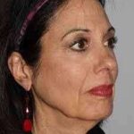 All Me Facelift Before & After Patient #770