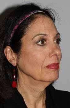 All Me Facelift Before & After Patient #770