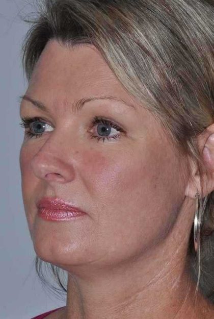 All Me Facelift Before & After Patient #781
