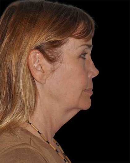 All Me Facelift Before & After Patient #297