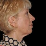 All Me Facelift Before & After Patient #308