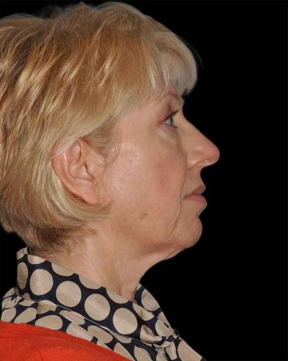 All Me Facelift Before & After Patient #308