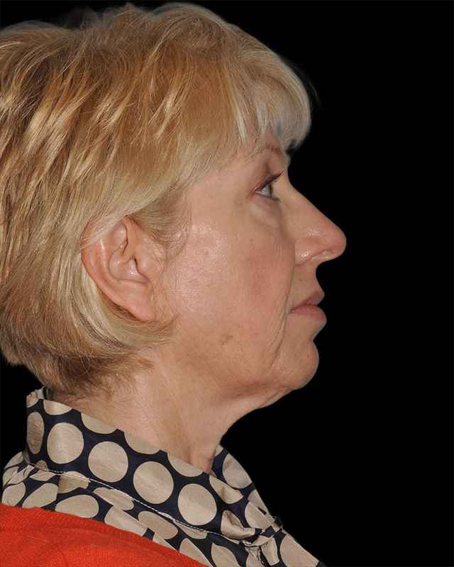 All Me Facelift Before & After Patient #308