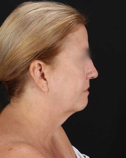 All Me Facelift Before & After Patient #320