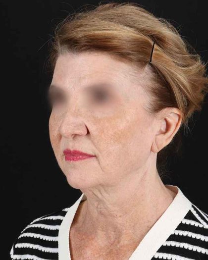 All Me Facelift Before & After Patient #240