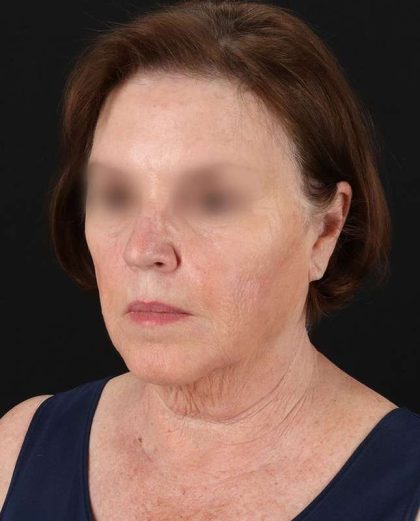 All Me Facelift Before & After Patient #354