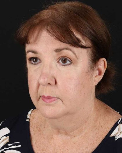 All Me Facelift Before & After Patient #366