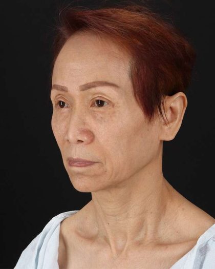 All Me Facelift Before & After Patient #395