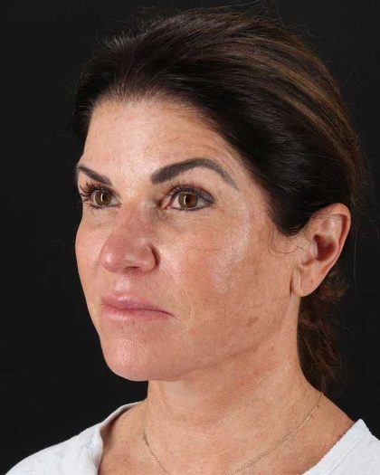 All Me Facelift Before & After Patient #406