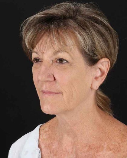 All Me Facelift Before & After Patient #418