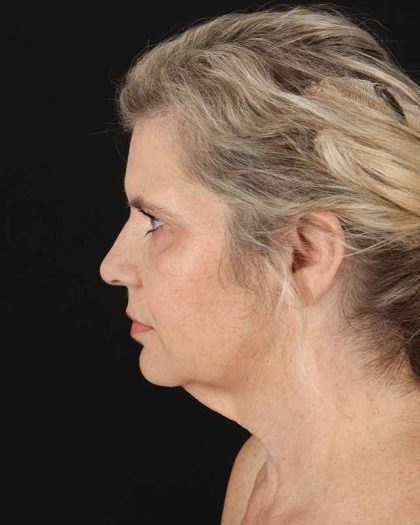 All Me Facelift Before & After Patient #428