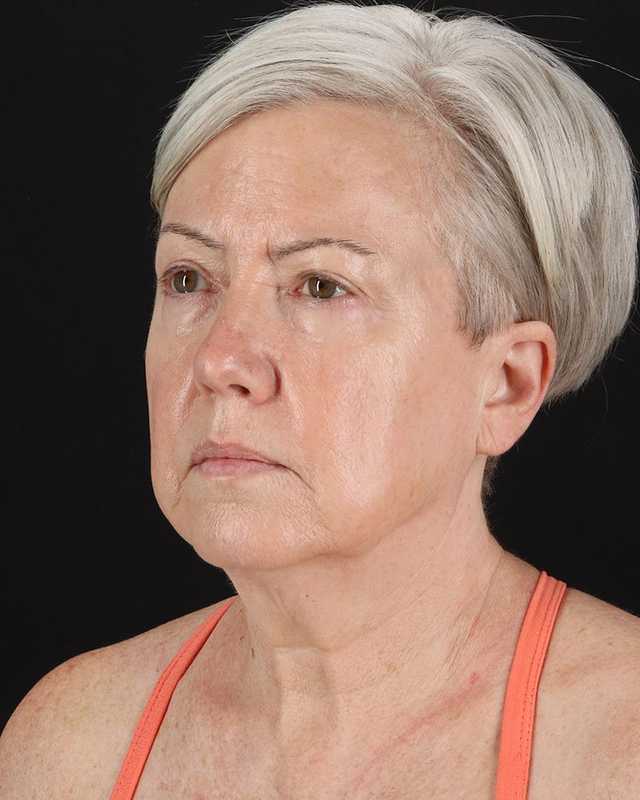 All Me Facelift Before & After Patient #439
