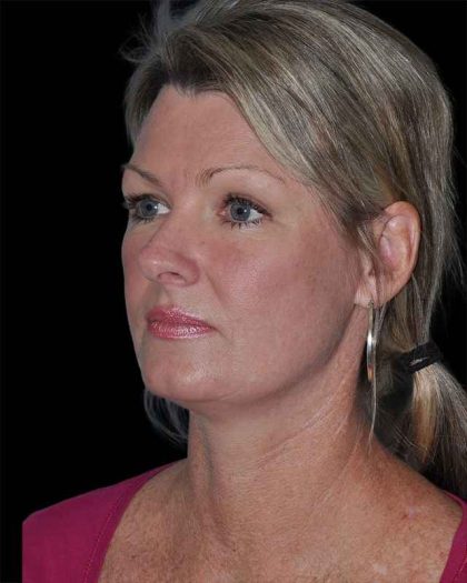 All Me Facelift Before & After Patient #252