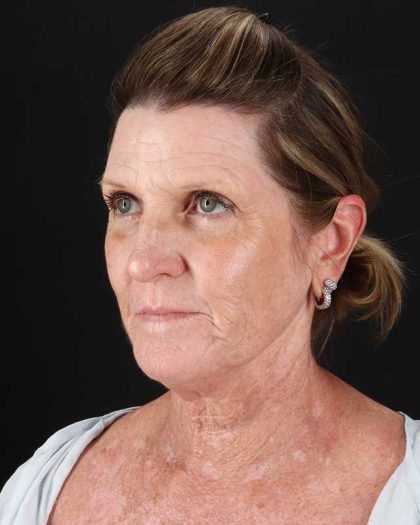 All Me Facelift Before & After Patient #461