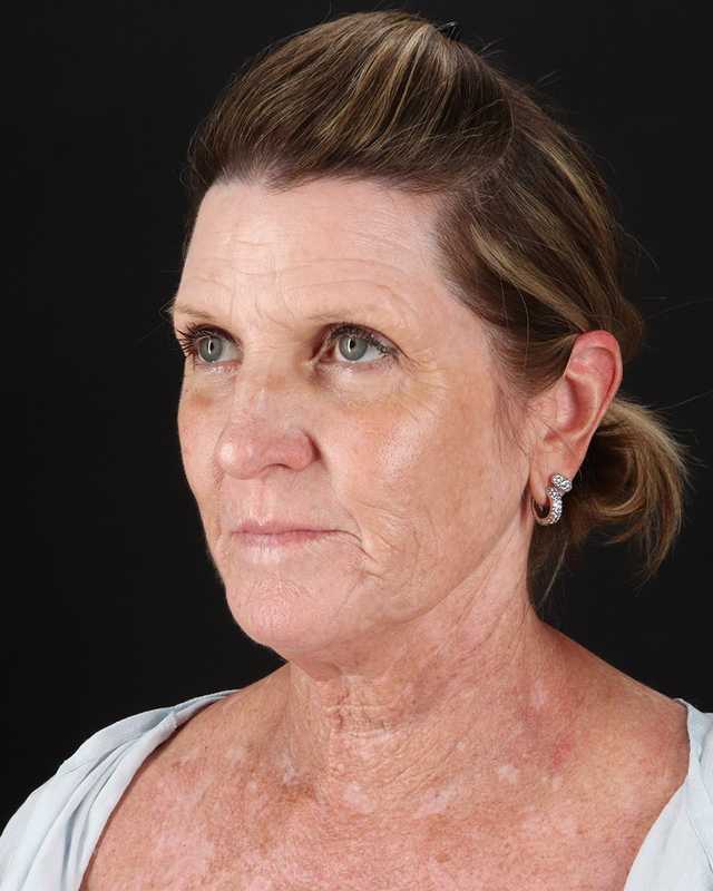 All Me Facelift Before & After Patient #461