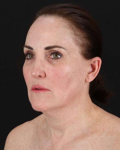 All Me Facelift Before & After Patient #472