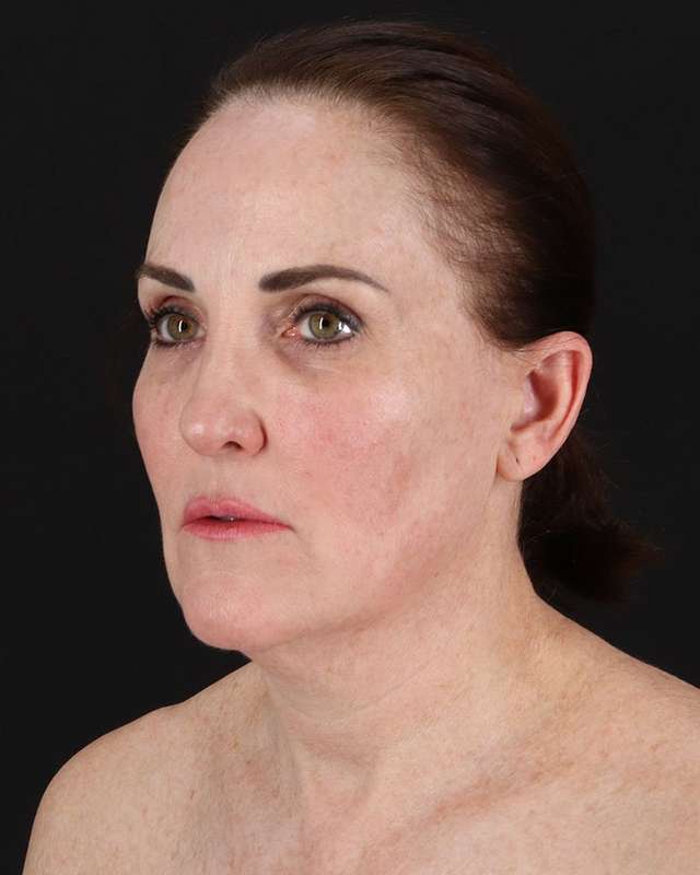 All Me Facelift Before & After Patient #472