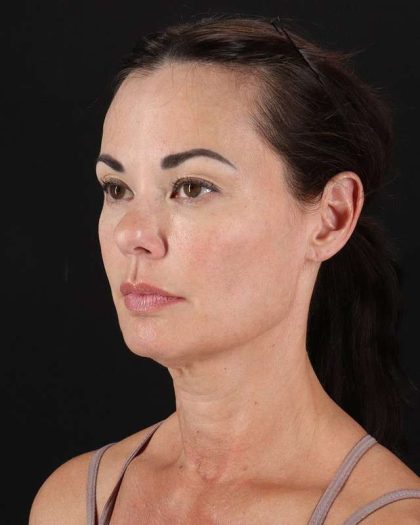 All Me Facelift Before & After Patient #483
