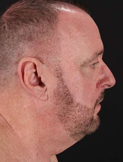 All Me Facelift Before & After Patient #728