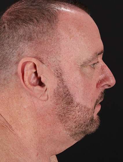 All Me Facelift Before & After Patient #728