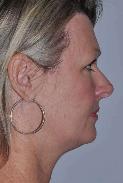All Me Facelift Before & After Patient #781