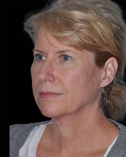 All Me Facelift Before & After Patient #263