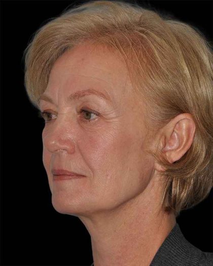 All Me Facelift Before & After Patient #274