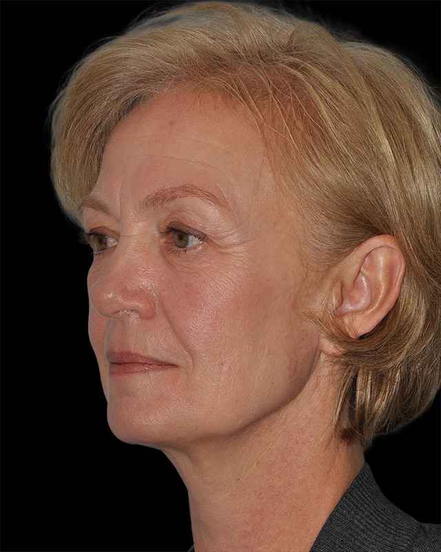 All Me Facelift Before & After Patient #274