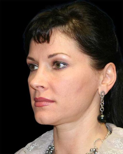 All Me Facelift Before & After Patient #286