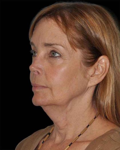 All Me Facelift Before & After Patient #297