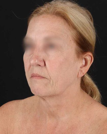 All Me Facelift Before & After Patient #320
