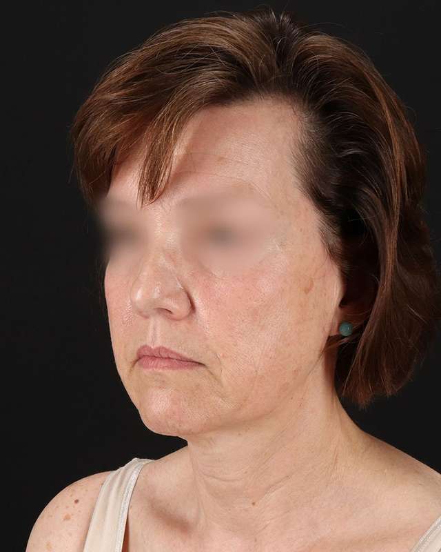 All Me Facelift Before & After Patient #229