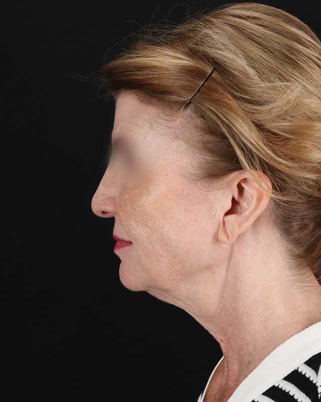 All Me Facelift Before & After Patient #240