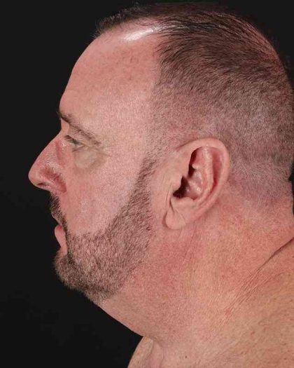 All Me Facelift Before & After Patient #343