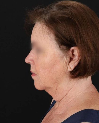 All Me Facelift Before & After Patient #354
