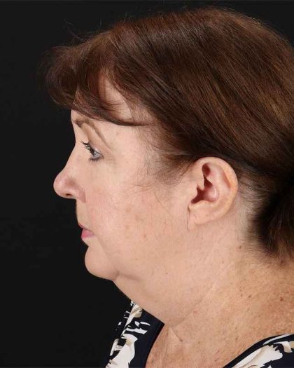 All Me Facelift Before & After Patient #366