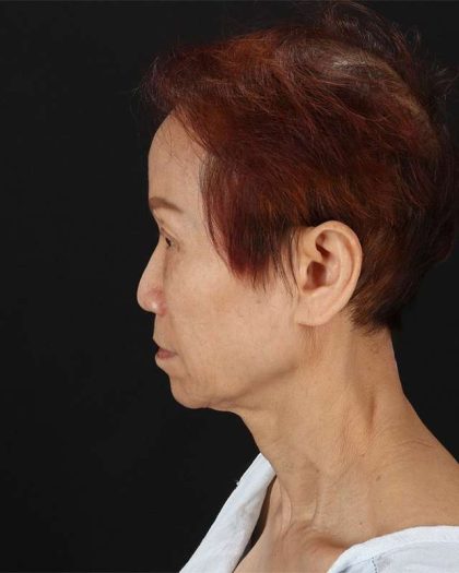 All Me Facelift Before & After Patient #395