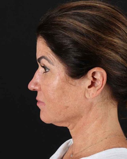 All Me Facelift Before & After Patient #406
