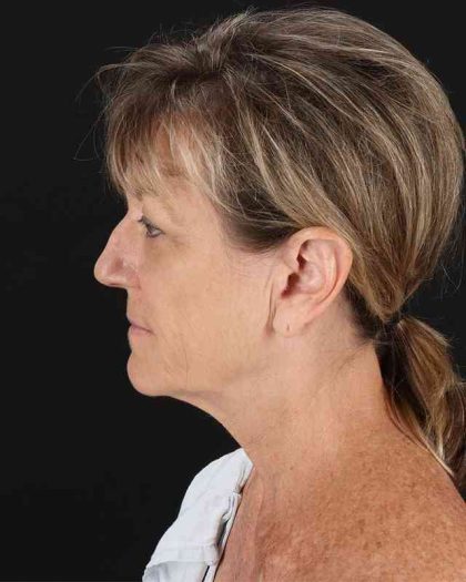 All Me Facelift Before & After Patient #418