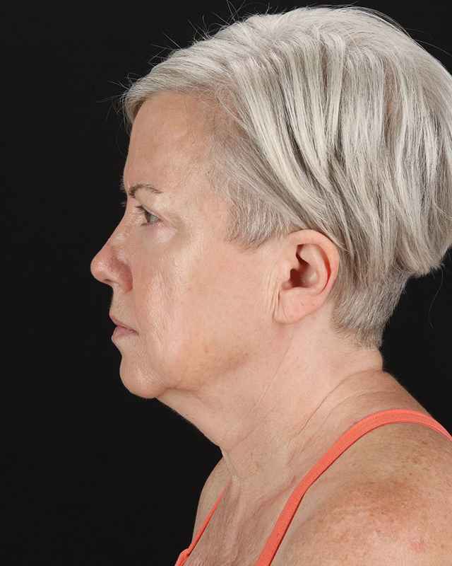 All Me Facelift Before & After Patient #439