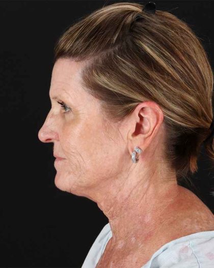 All Me Facelift Before & After Patient #461
