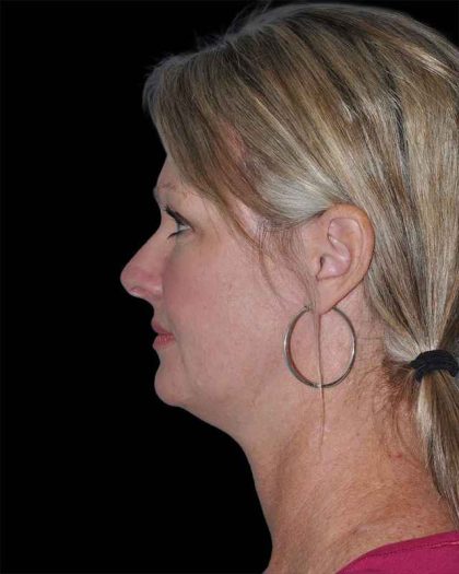 All Me Facelift Before & After Patient #252